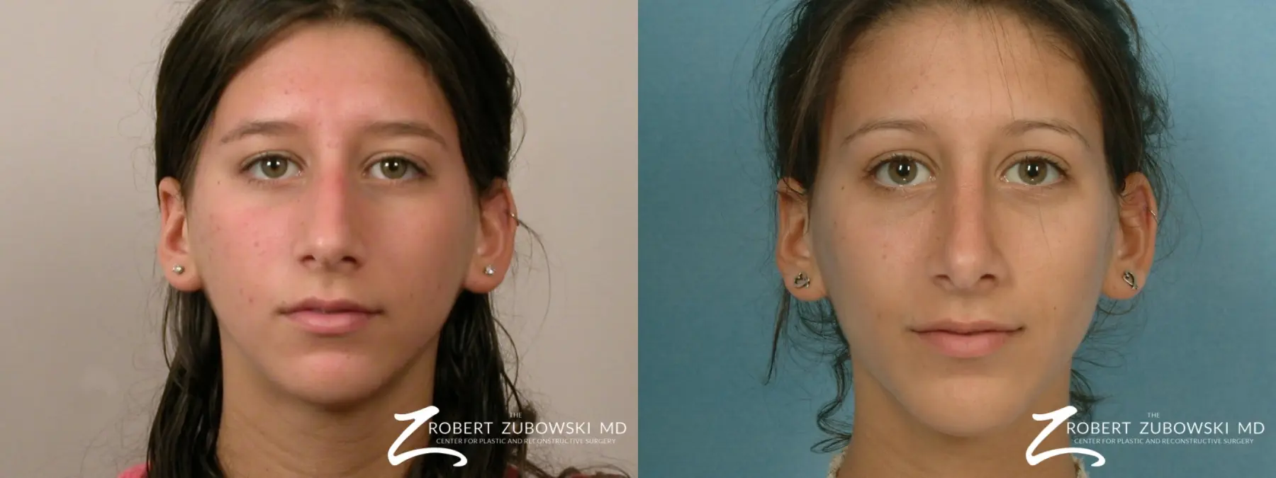 Rhinoplasty: Patient 30 - Before and After 1