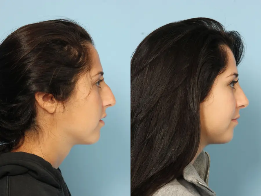 Rhinoplasty: Patient 20 - Before and After 3