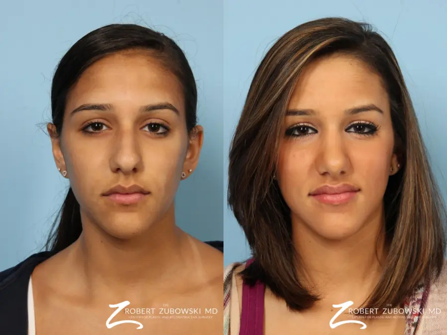Rhinoplasty: Patient 14 - Before and After  
