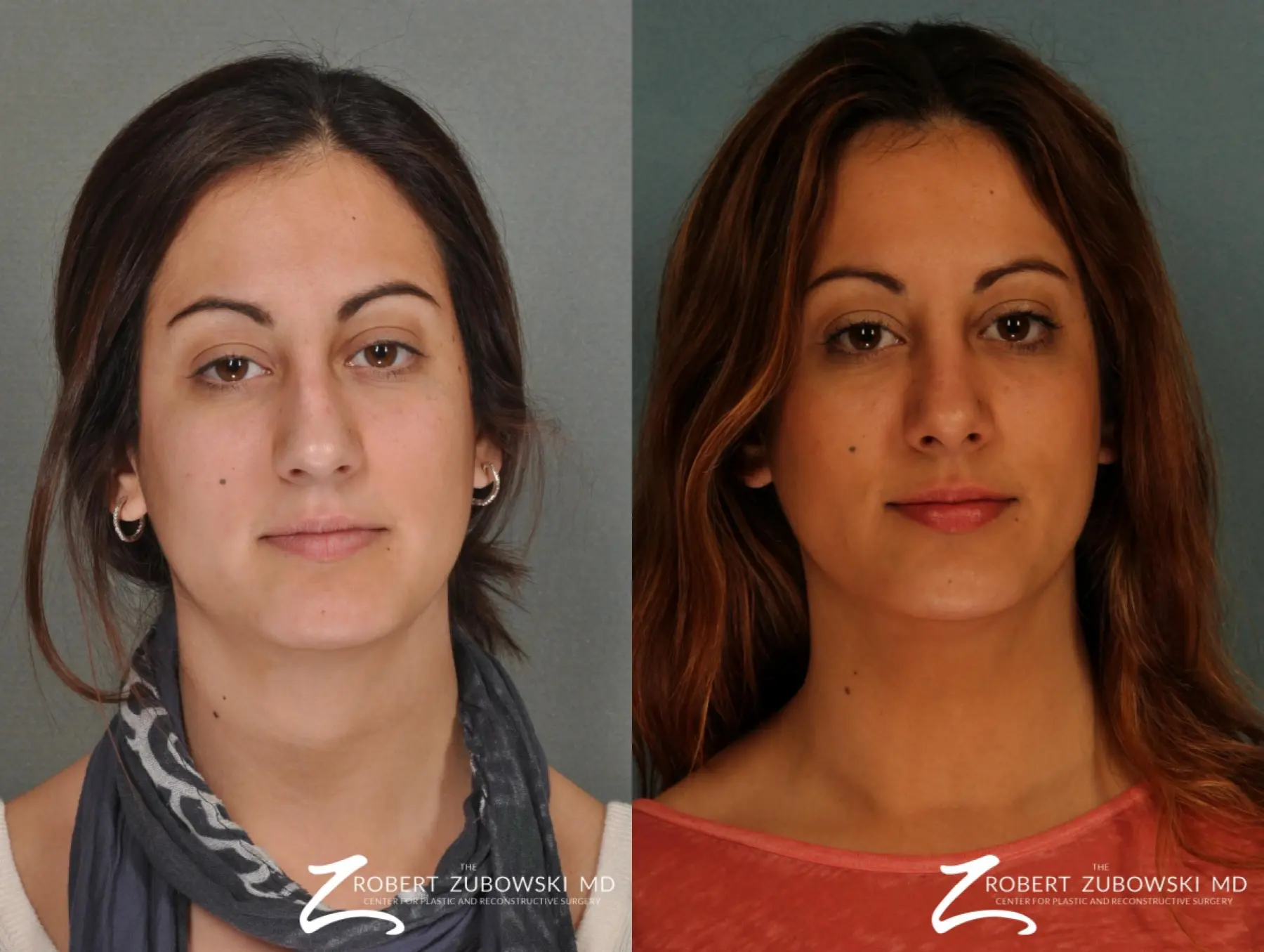 Rhinoplasty: Patient 7 - Before and After  