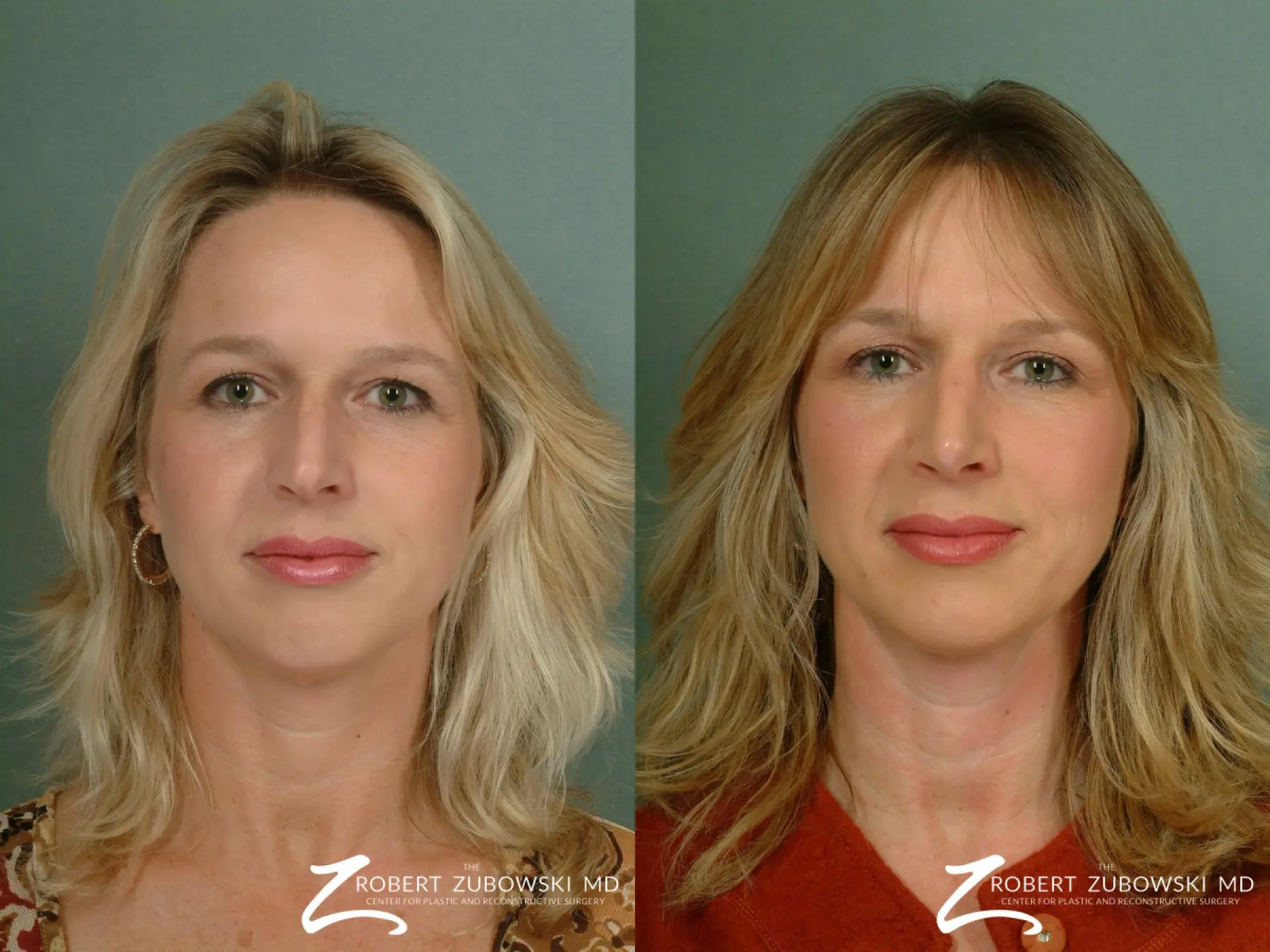 Rhinoplasty: Patient 22 - Before and After  