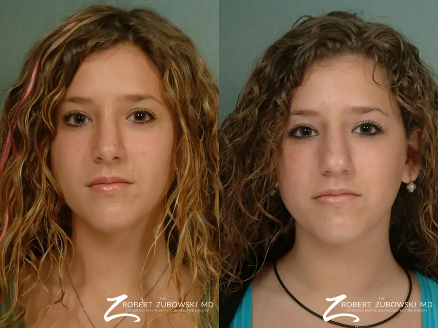 Rhinoplasty: Patient 12 - Before and After  