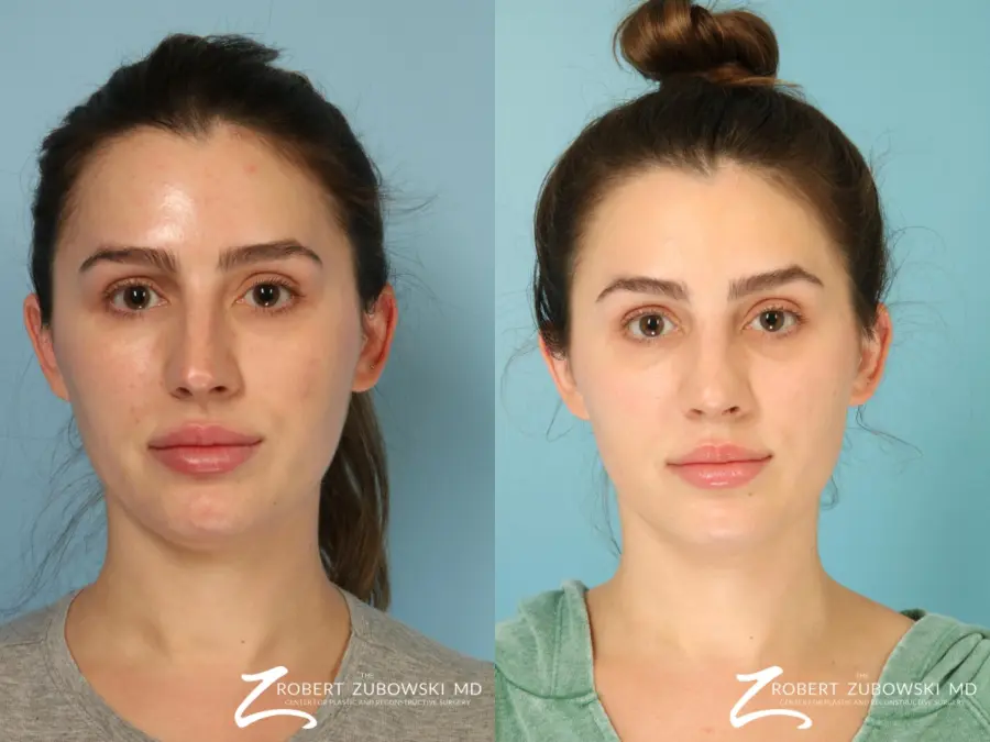 Rhinoplasty: Patient 26 - Before and After  