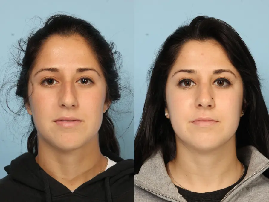 Rhinoplasty: Patient 20 - Before and After  