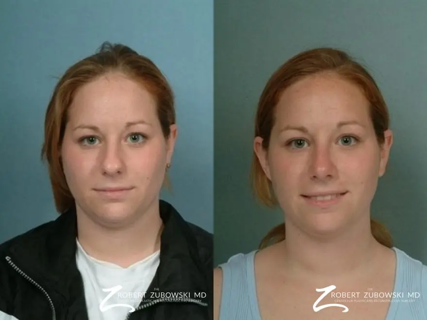 Rhinoplasty: Patient 5 - Before and After 1