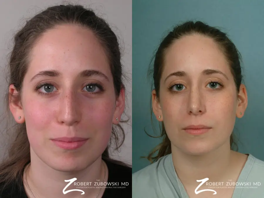 Rhinoplasty: Patient 7 - Before and After  