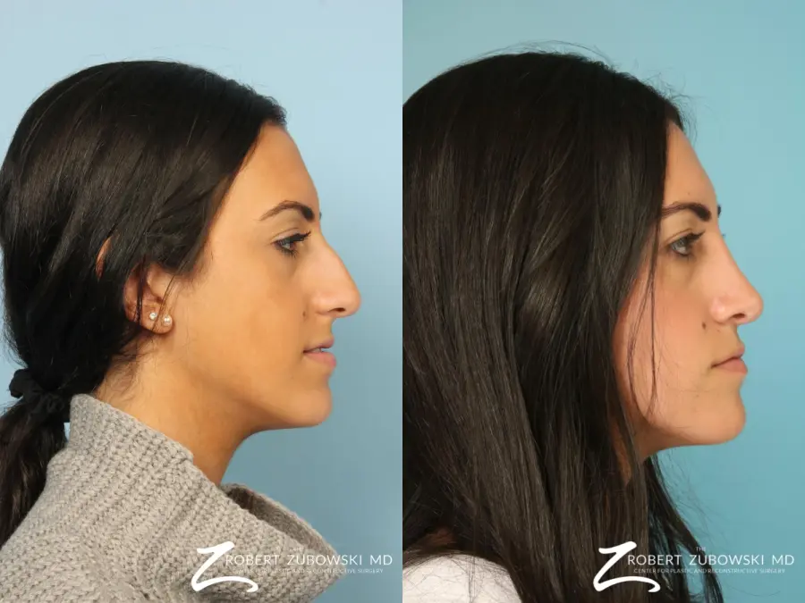 Rhinoplasty: Patient 33 - Before and After 2