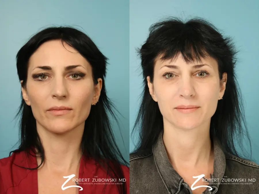 Rhinoplasty: Patient 32 - Before and After 1
