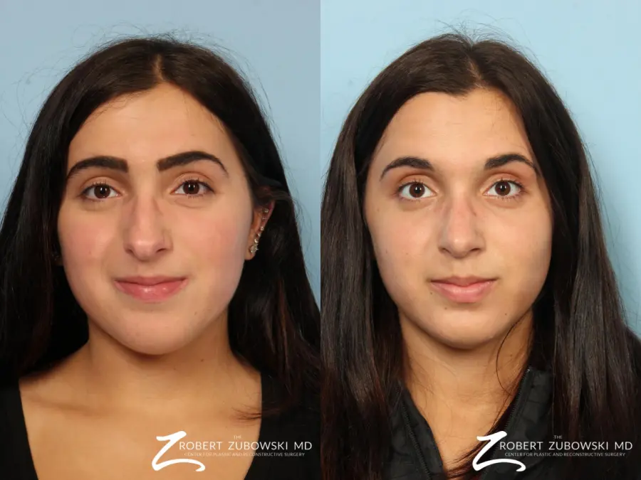 Rhinoplasty: Patient 24 - Before and After  