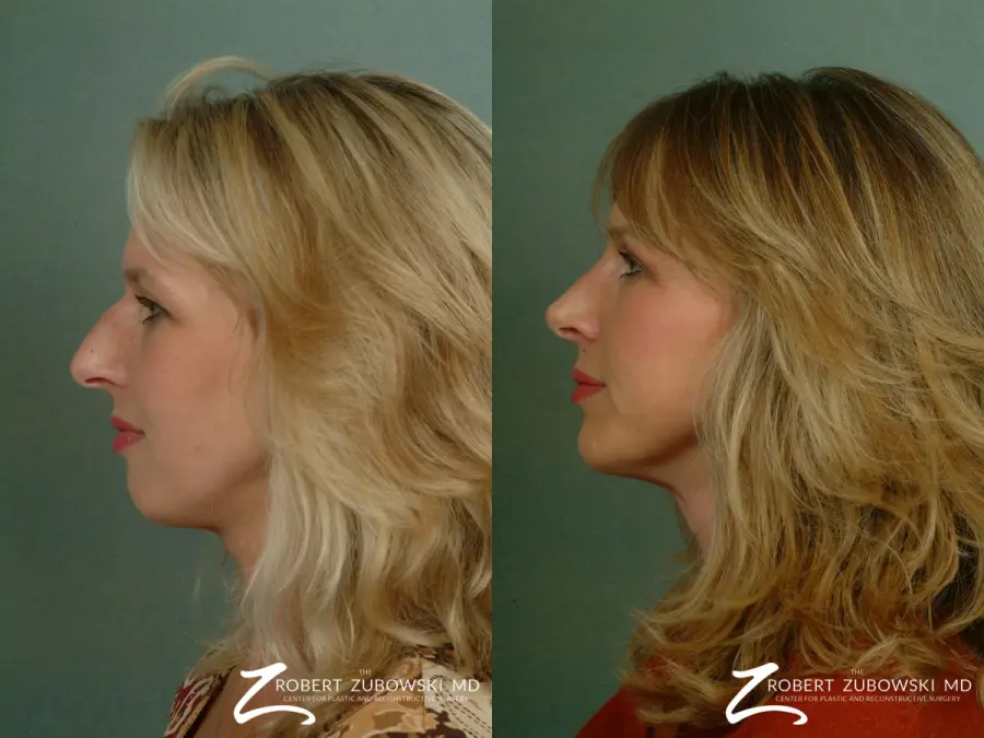 Rhinoplasty: Patient 22 - Before and After 2