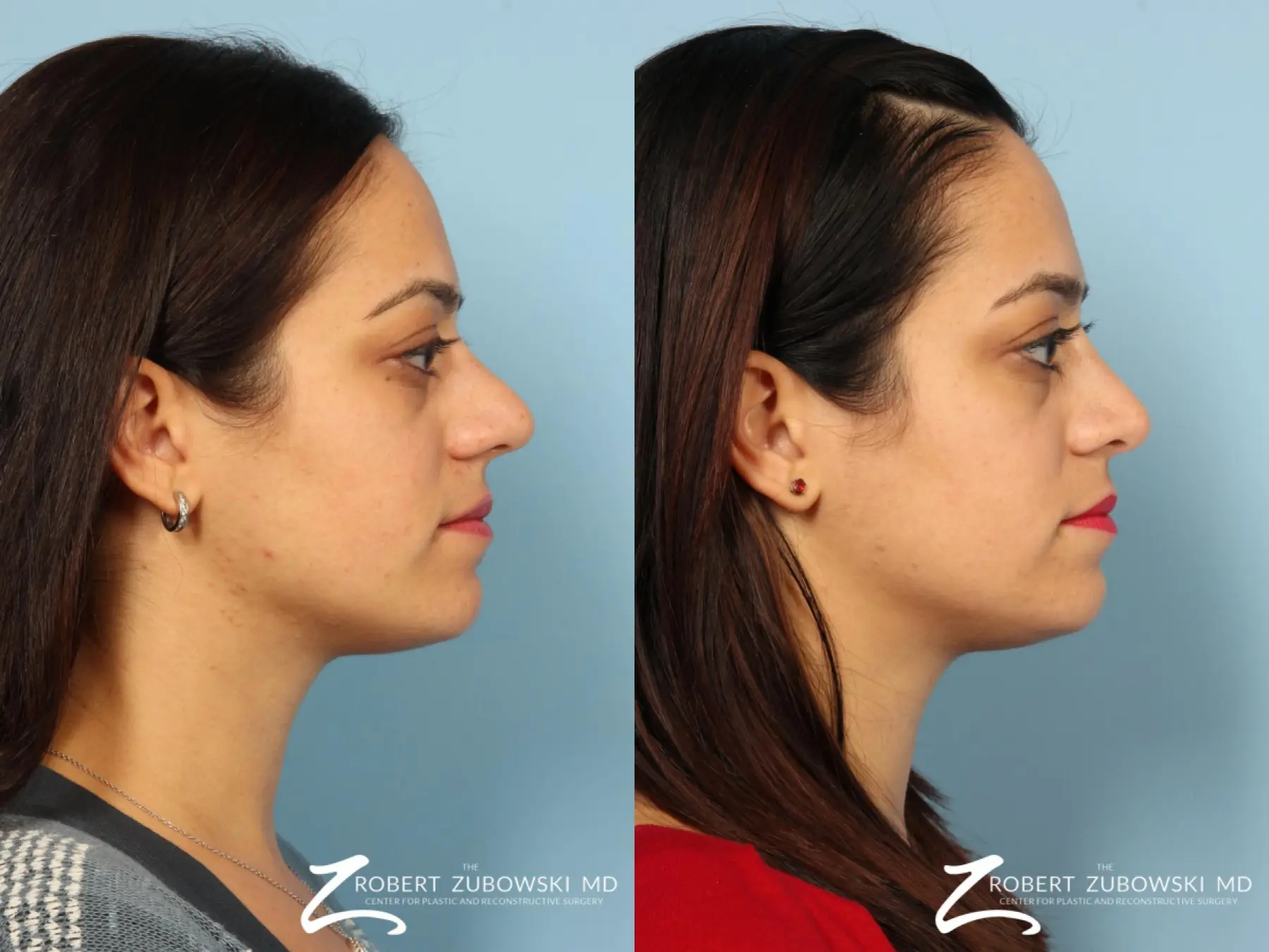 Rhinoplasty: Patient 25 - Before and After 2