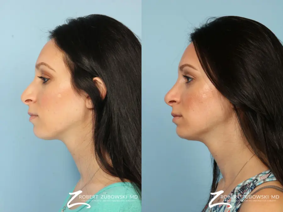 Rhinoplasty: Patient 16 - Before and After 2