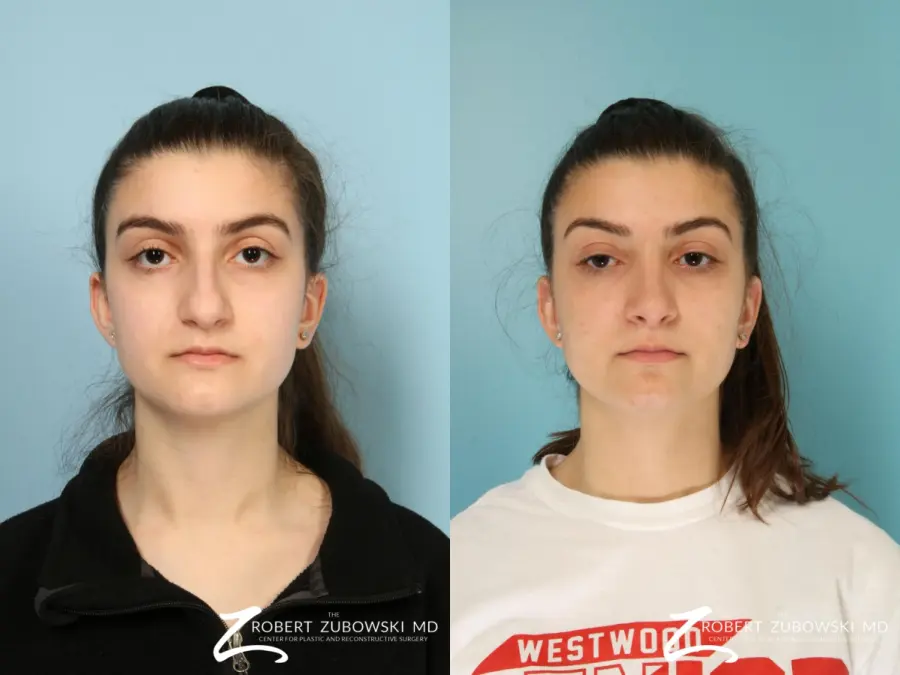 Rhinoplasty: Patient 28 - Before and After  