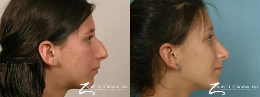 Rhinoplasty: Patient 30 - Before and After 2