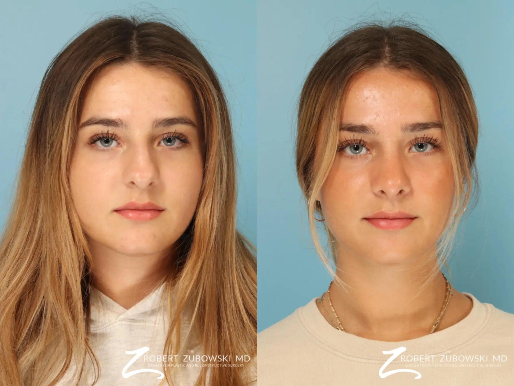 Rhinoplasty: Patient 35 - Before and After  