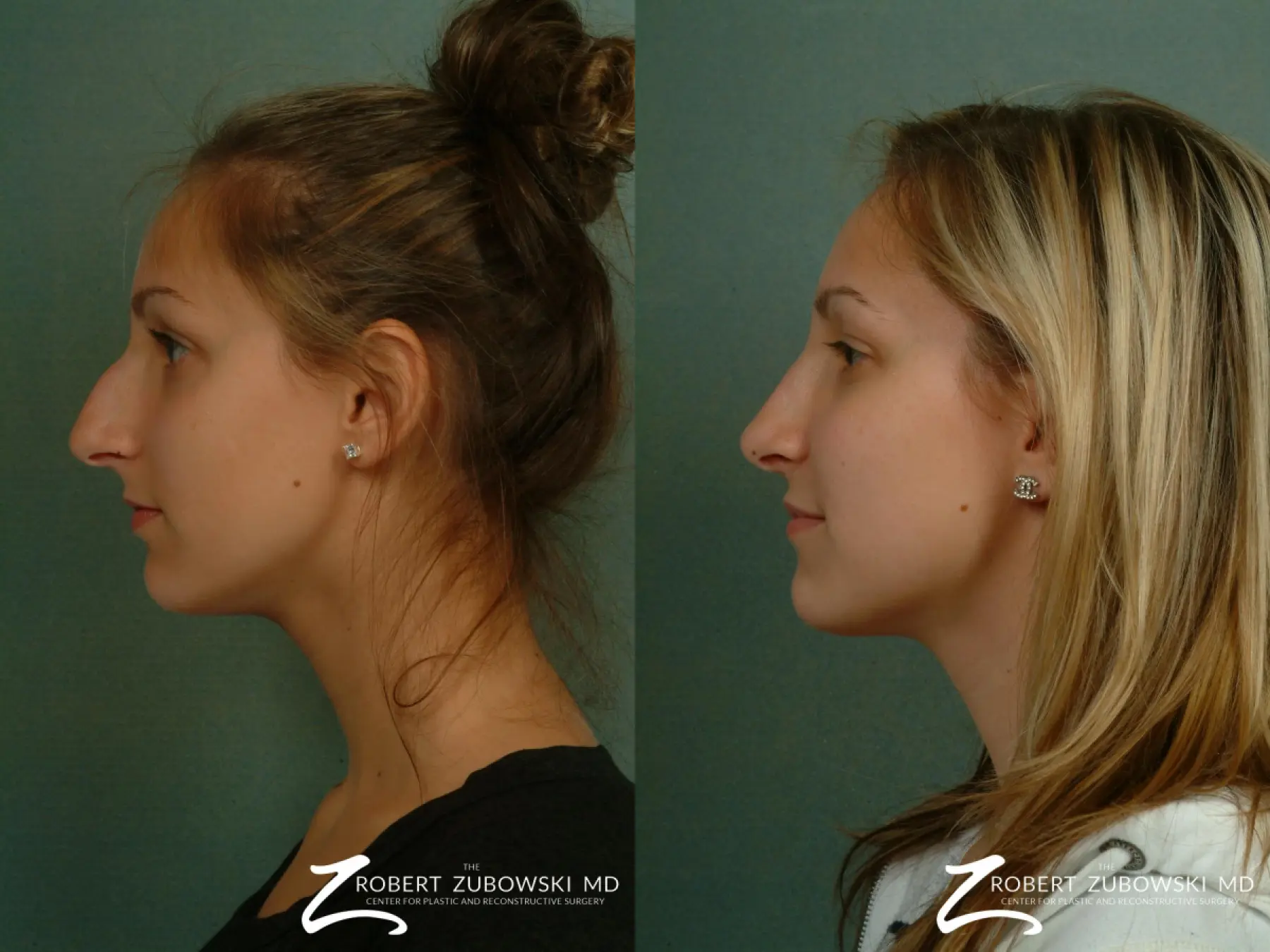 Rhinoplasty: Patient 26 - Before and After 2