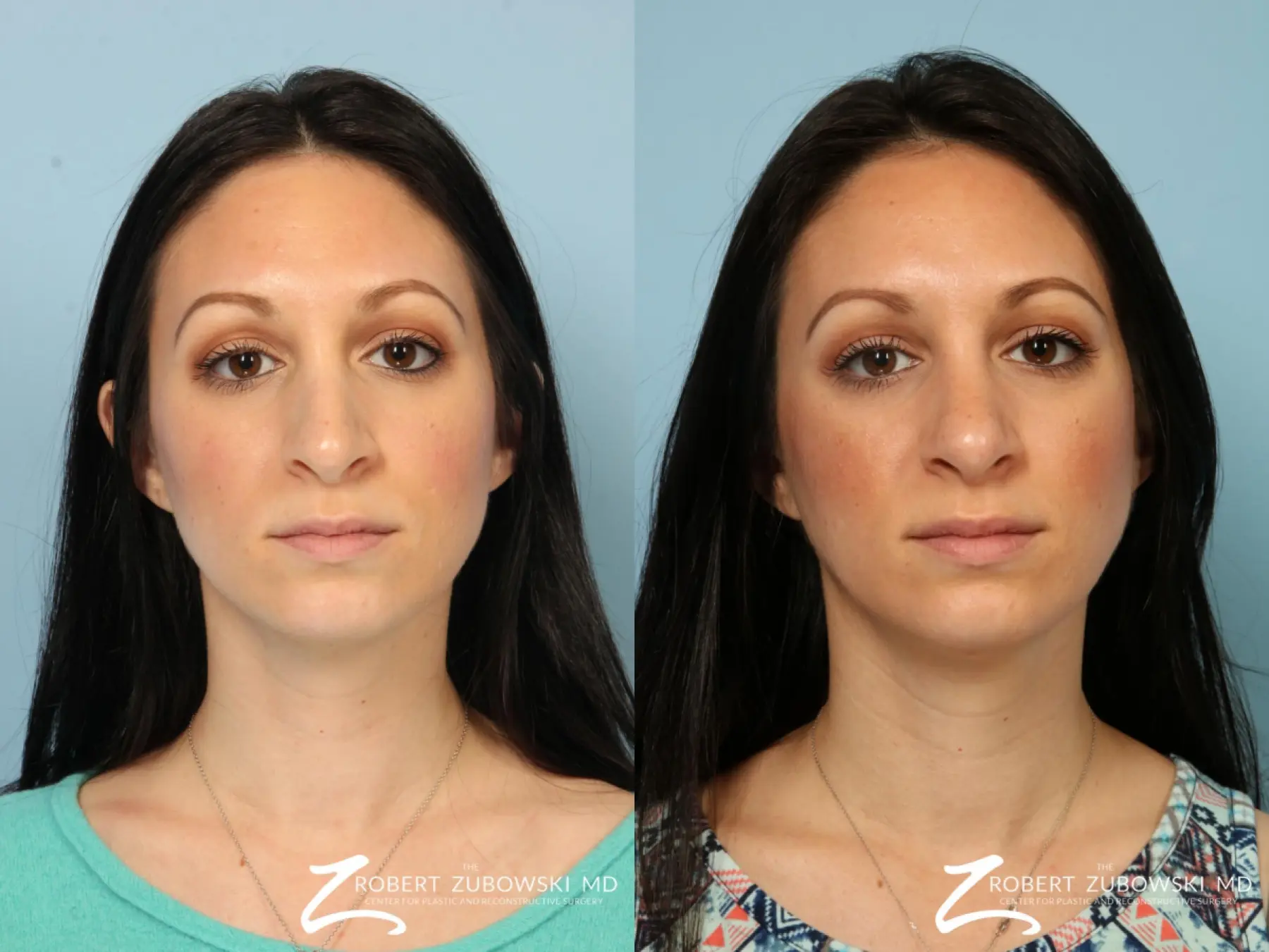 Rhinoplasty: Patient 16 - Before and After 1
