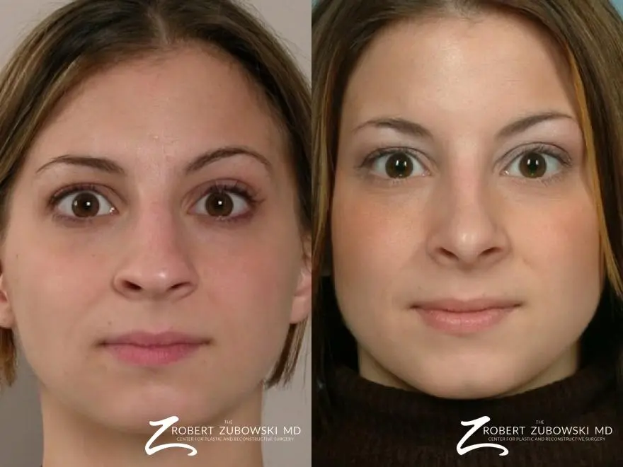 Rhinoplasty: Patient 21 - Before and After  
