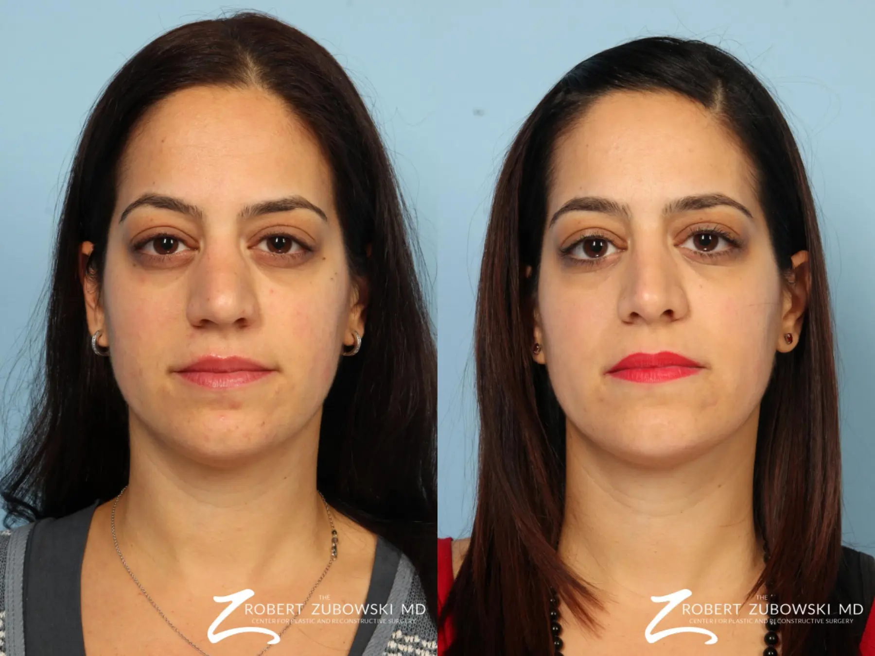 Rhinoplasty: Patient 25 - Before and After 1