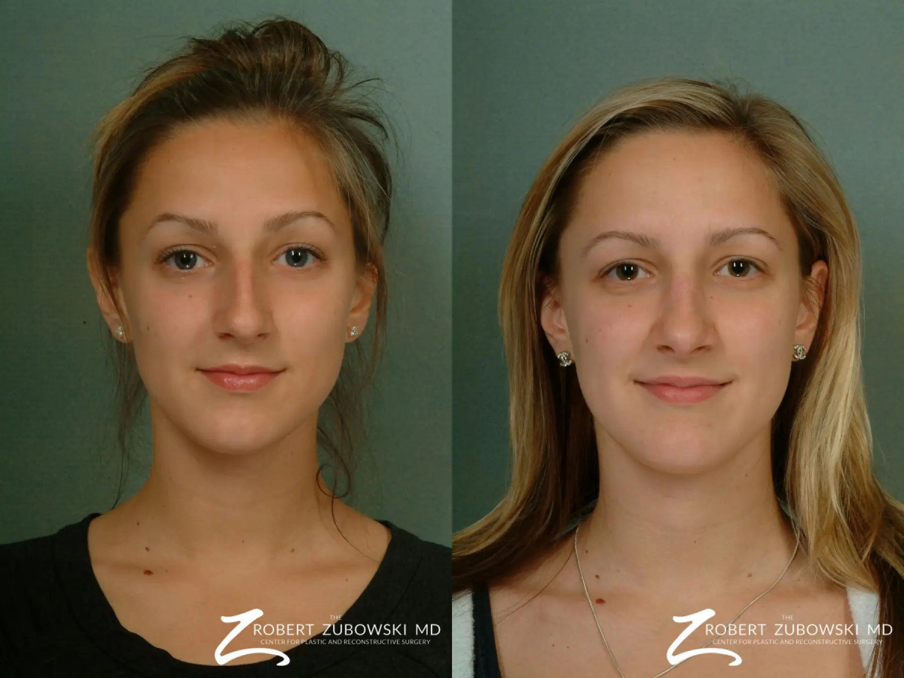 Rhinoplasty: Patient 26 - Before and After 1