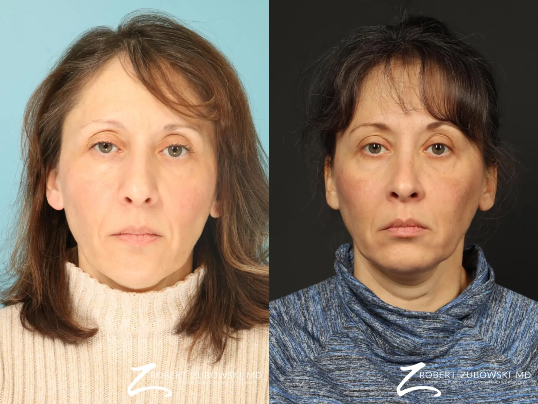 Rhinoplasty: Patient 36 - Before and After  