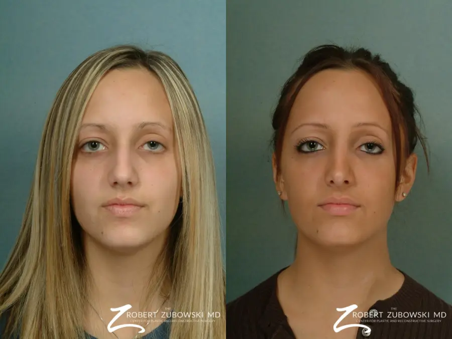 Rhinoplasty: Patient 24 - Before and After 1