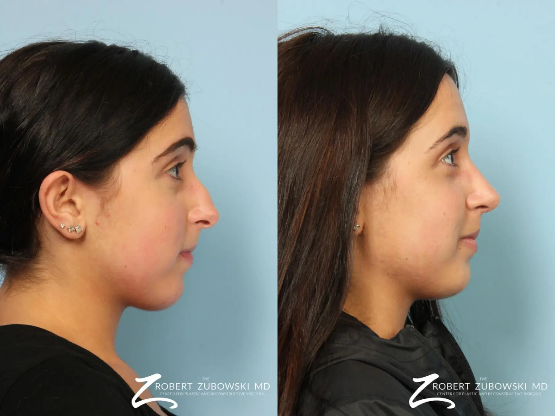 Rhinoplasty: Patient 15 - Before and After 2