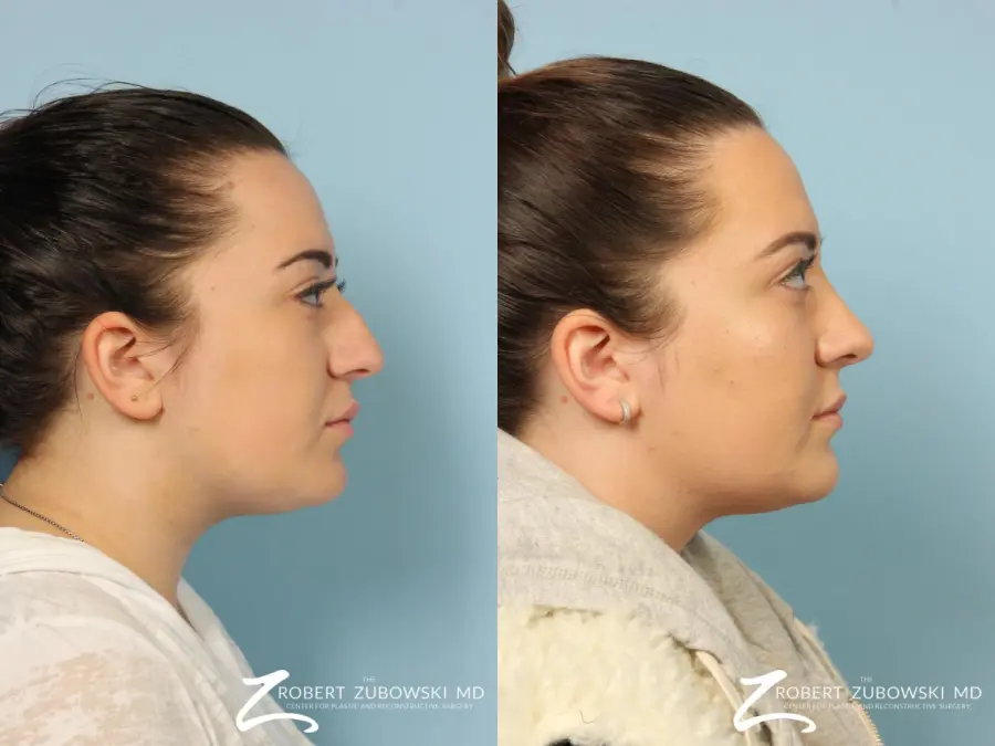 Rhinoplasty: Patient 12 - Before and After 3