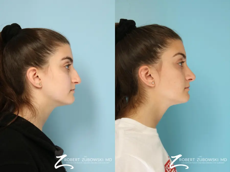 Rhinoplasty: Patient 28 - Before and After 2