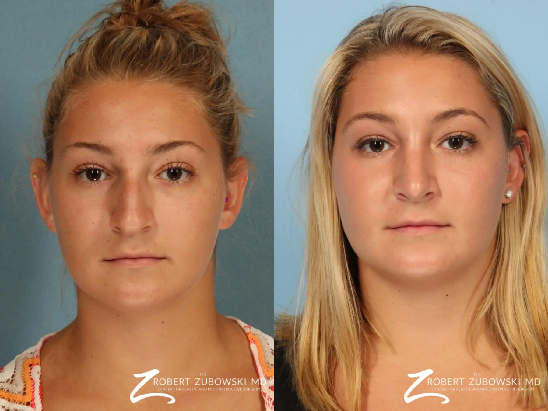 Rhinoplasty: Patient 9 - Before and After  