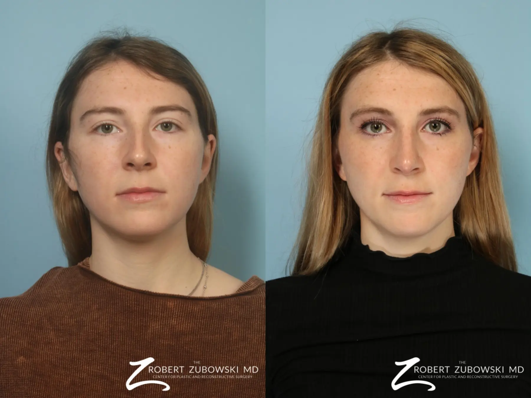 Rhinoplasty: Patient 18 - Before and After  