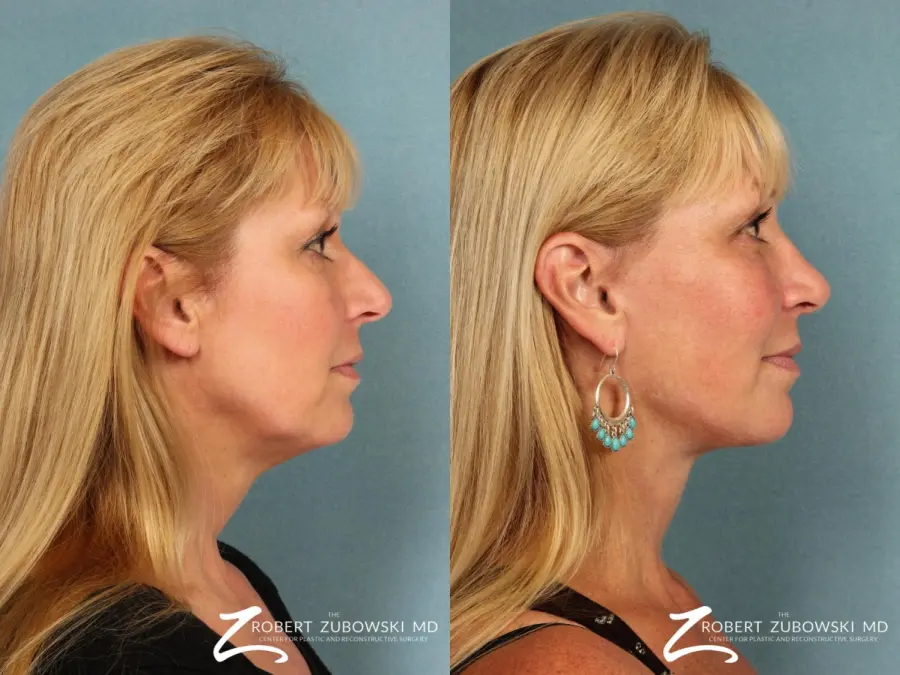 Rhinoplasty: Patient 8 - Before and After 2