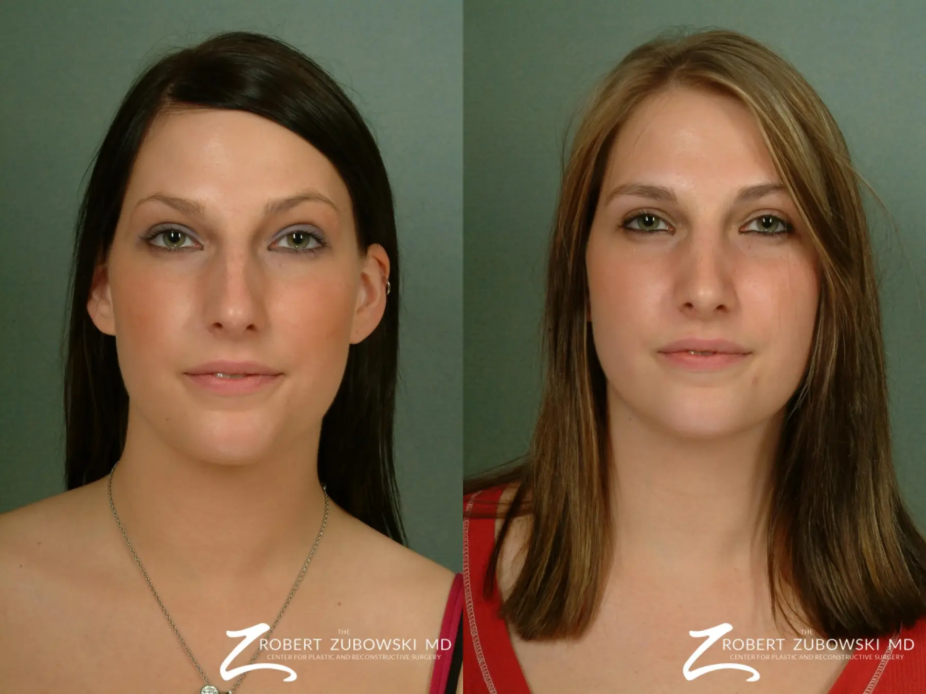 Rhinoplasty: Patient 3 - Before and After  