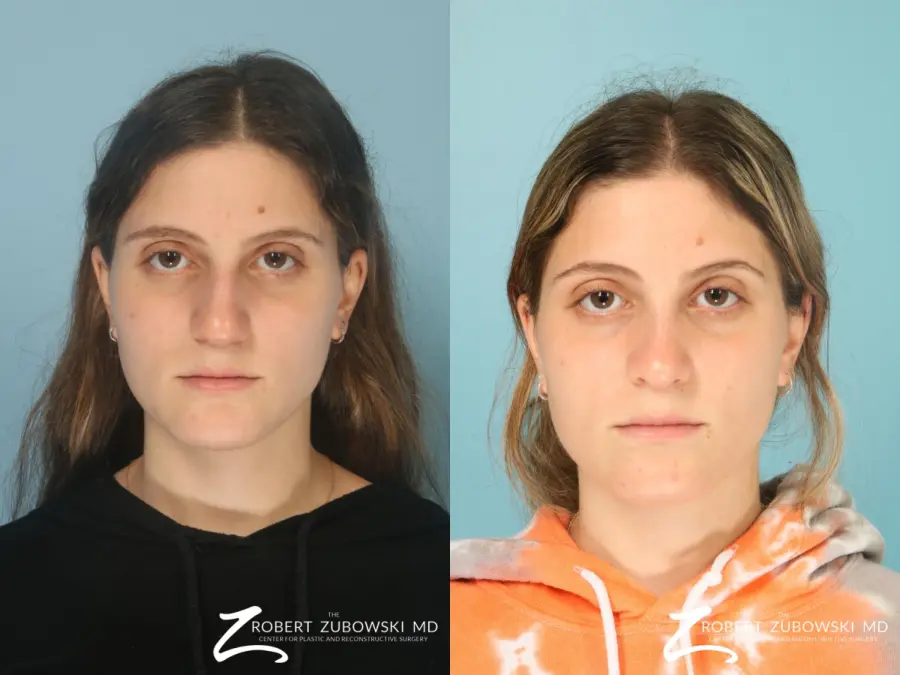 Rhinoplasty: Patient 29 - Before and After  