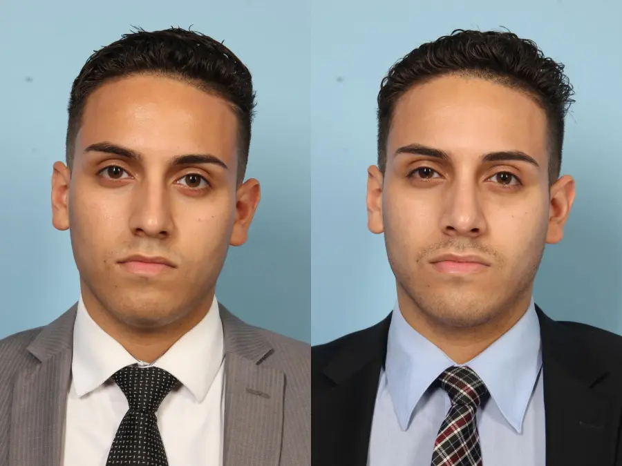 Rhinoplasty: Patient 3 - Before and After 1