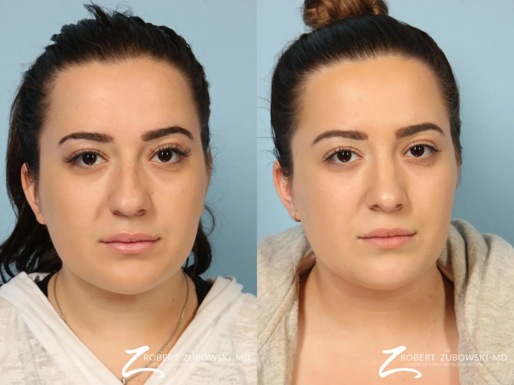 Rhinoplasty: Patient 12 - Before and After  