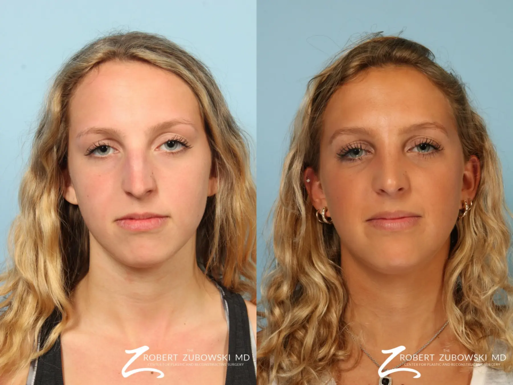 Rhinoplasty: Patient 13 - Before and After  