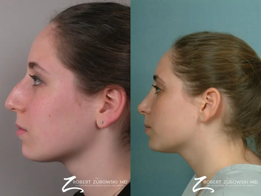 Rhinoplasty: Patient 6 - Before and After 2