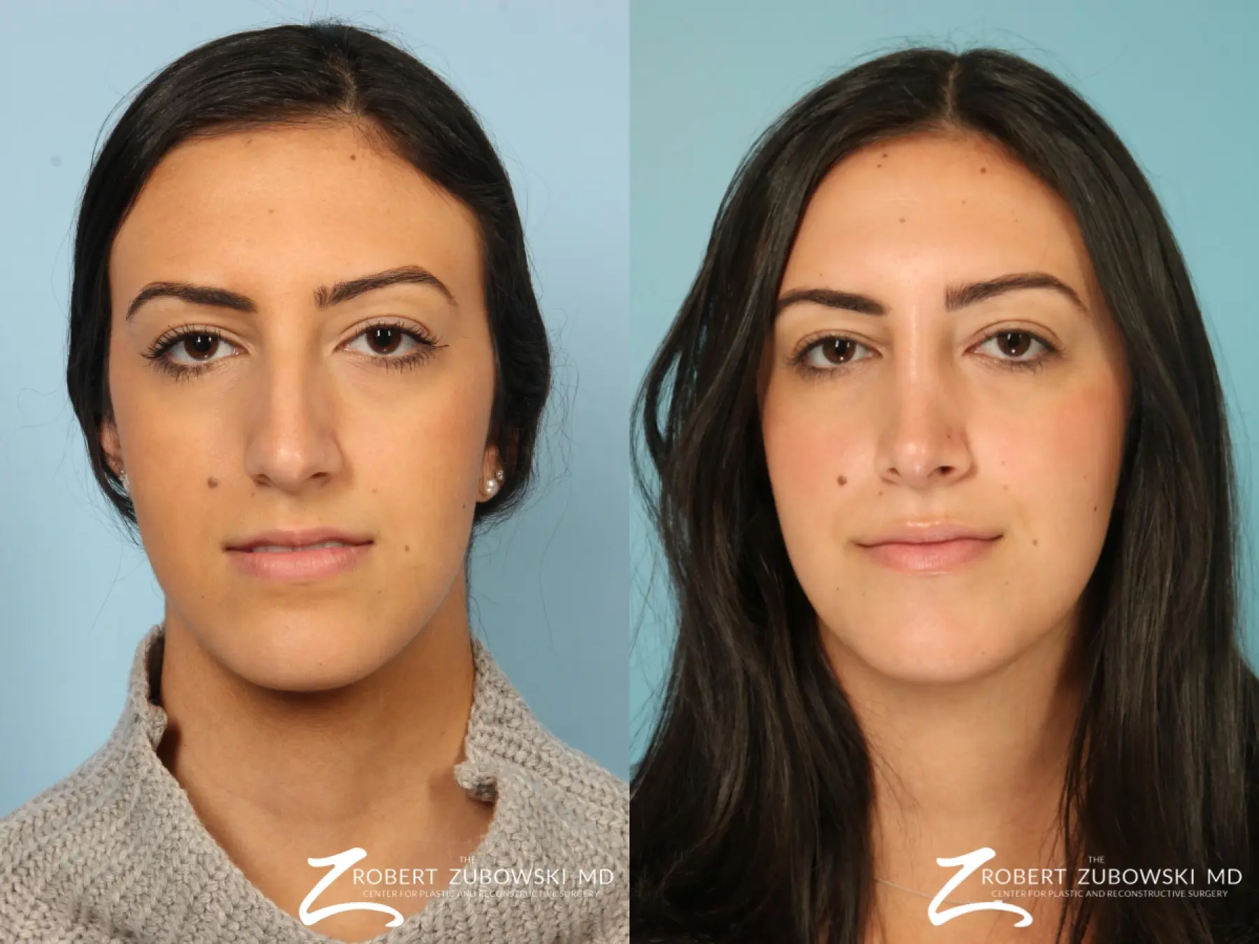 Rhinoplasty: Patient 33 - Before and After  