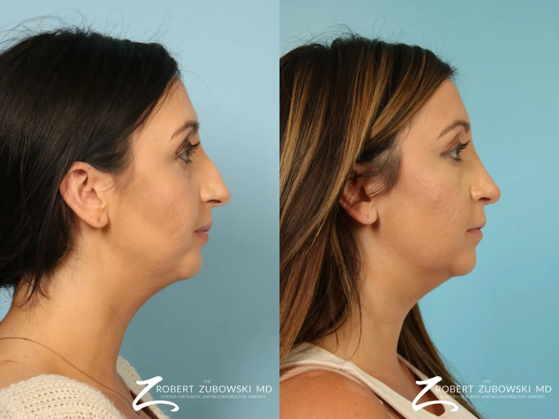 Rhinoplasty: Patient 29 - Before and After 2