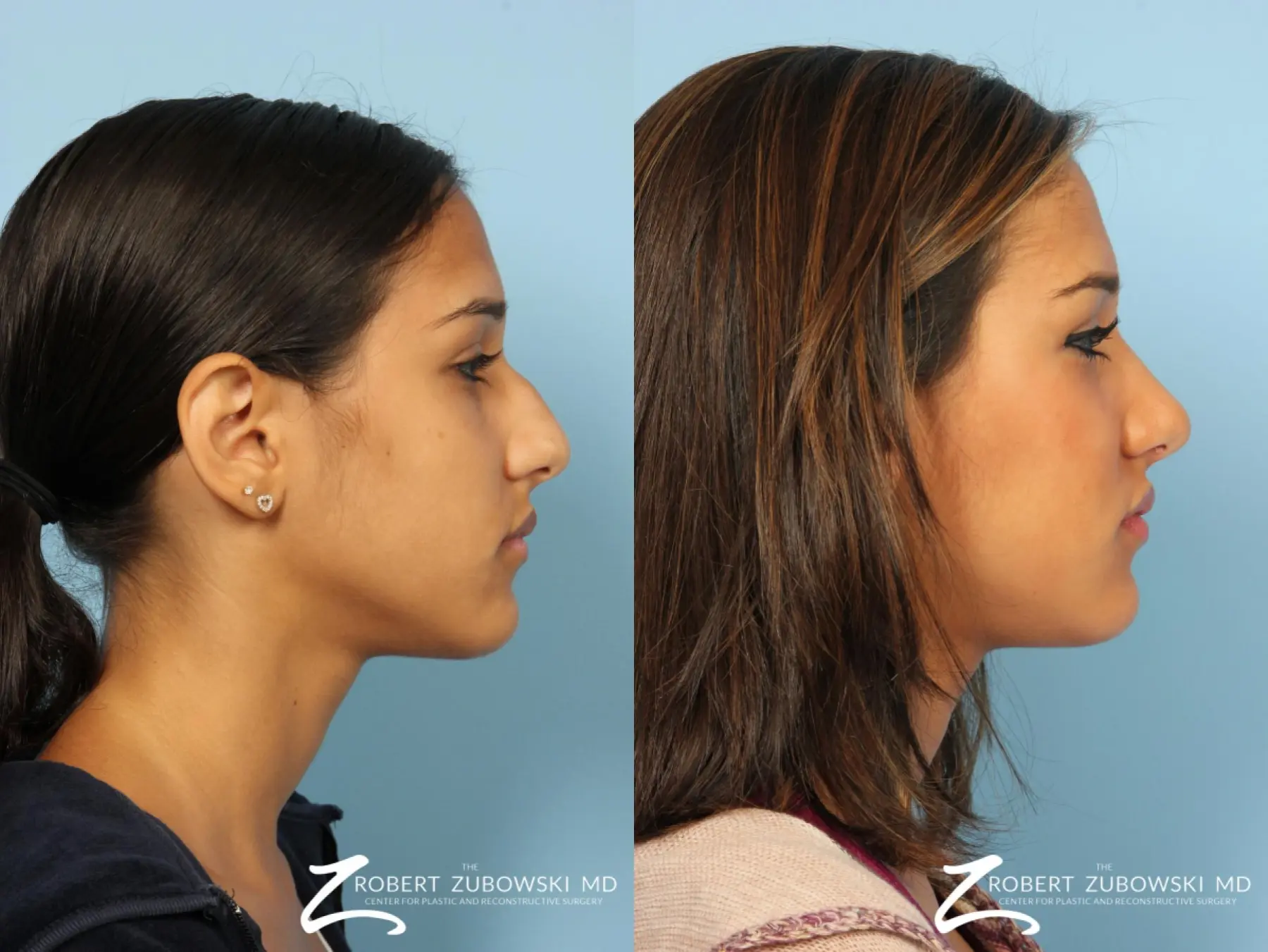 Rhinoplasty: Patient 23 - Before and After 2
