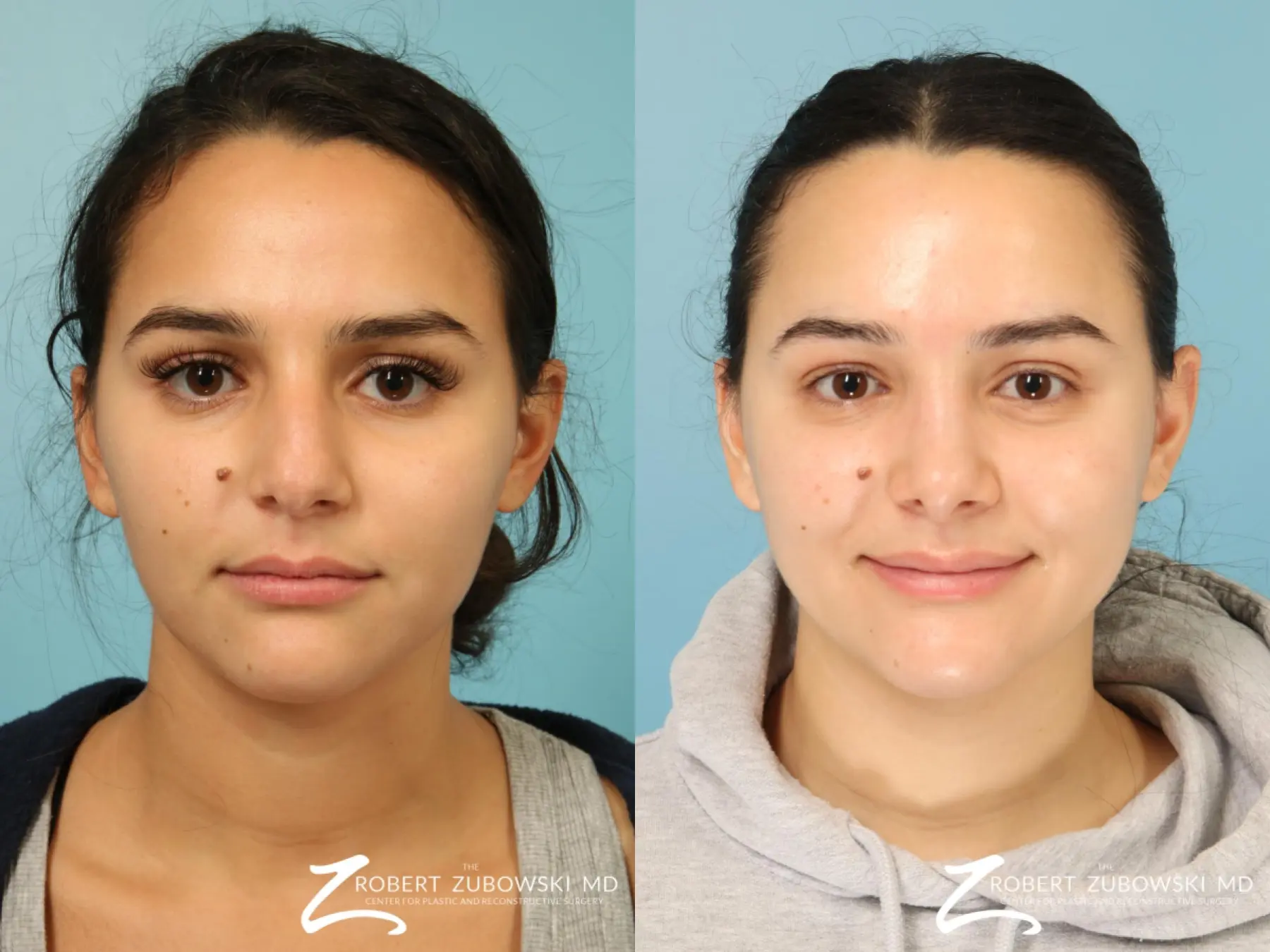 Rhinoplasty: Patient 31 - Before and After 1