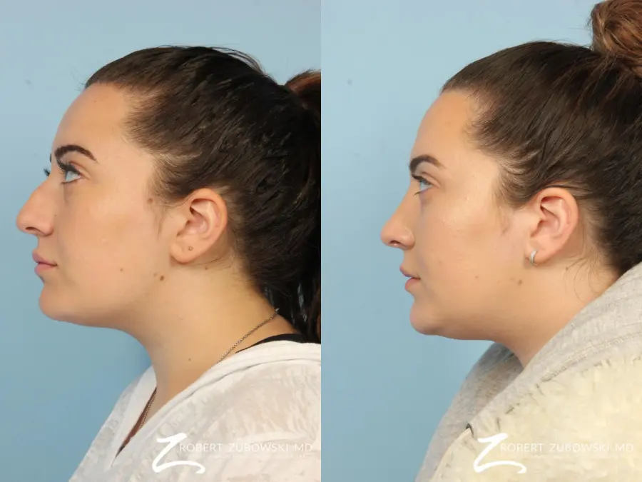 Rhinoplasty: Patient 12 - Before and After 2
