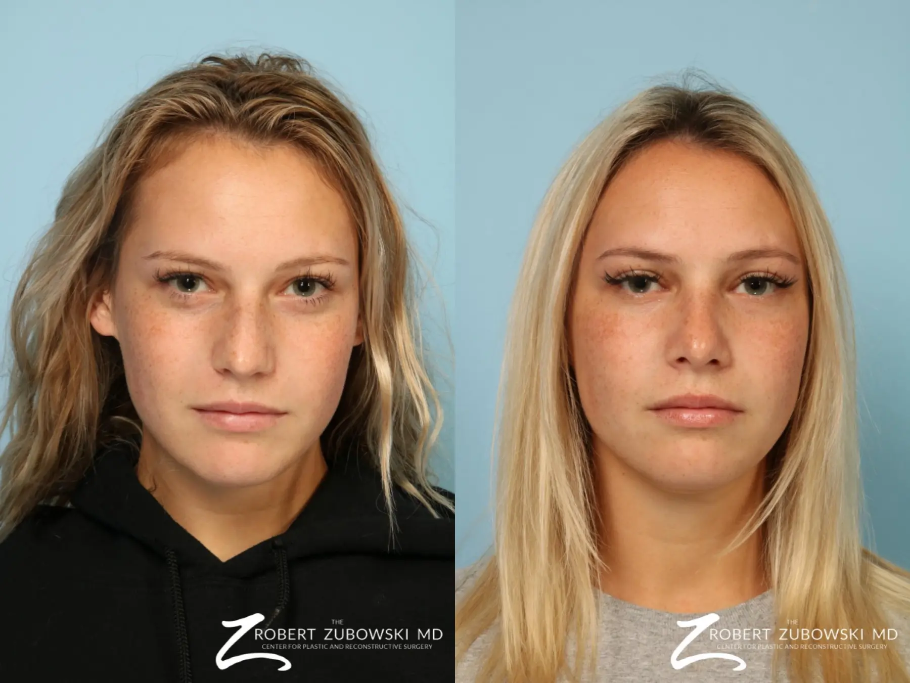 Rhinoplasty: Patient 14 - Before and After  