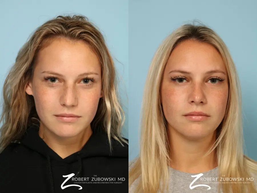 Rhinoplasty: Patient 23 - Before and After  