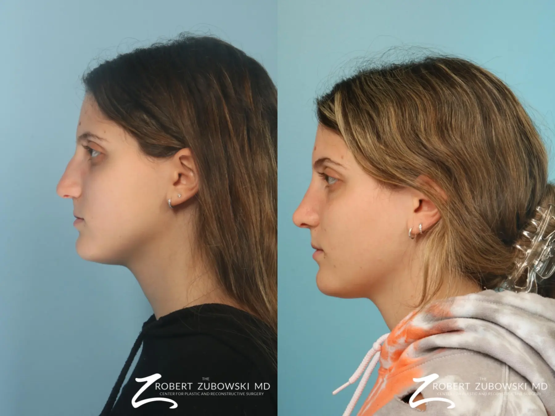 Rhinoplasty: Patient 17 - Before and After 2