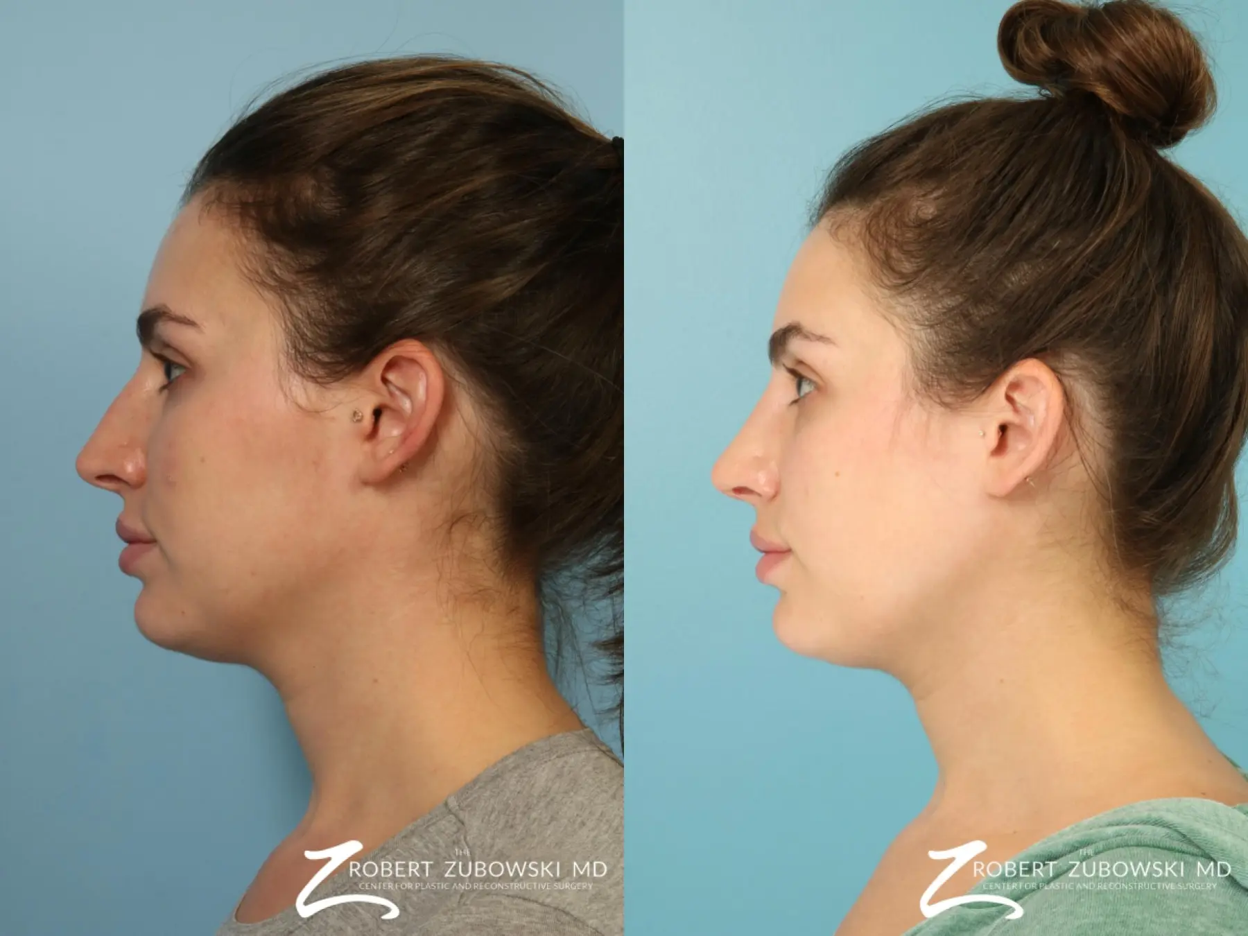 Rhinoplasty: Patient 27 - Before and After 2