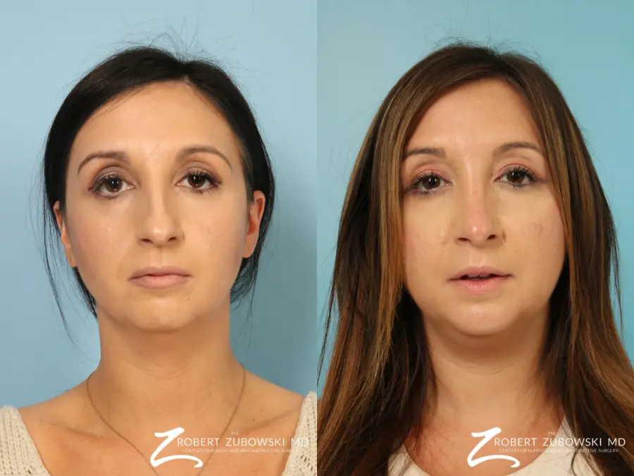 Rhinoplasty: Patient 27 - Before and After  