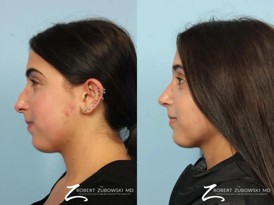 Rhinoplasty: Patient 15 - Before and After 3