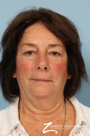 Blepharoplasty: Patient 37 - Before Image 1